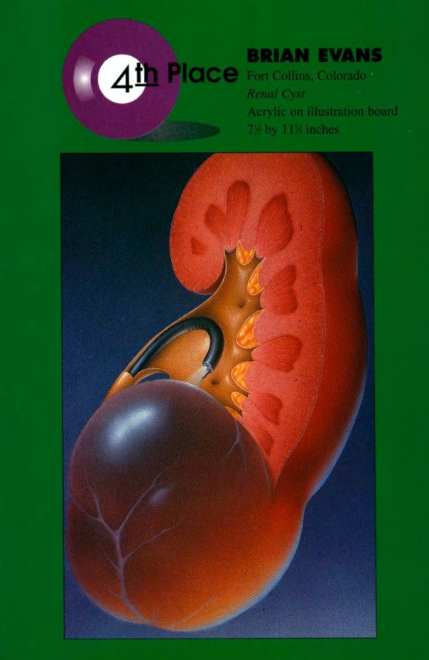 Renal Cyst Airbrush Action. May-June 1994.